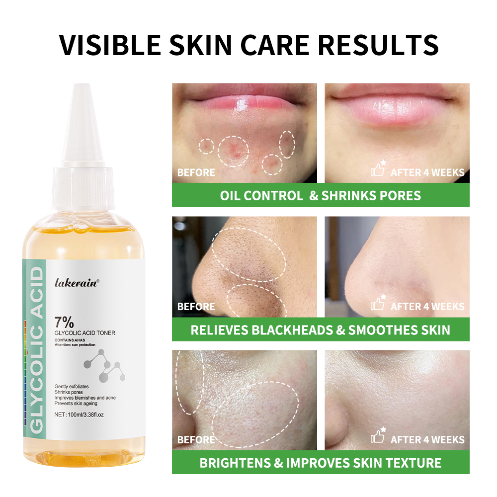 顔のスキンケアソリューション,通常のにきび除去剤,引き締め, - Lactic Acid Toner のレビューと価格